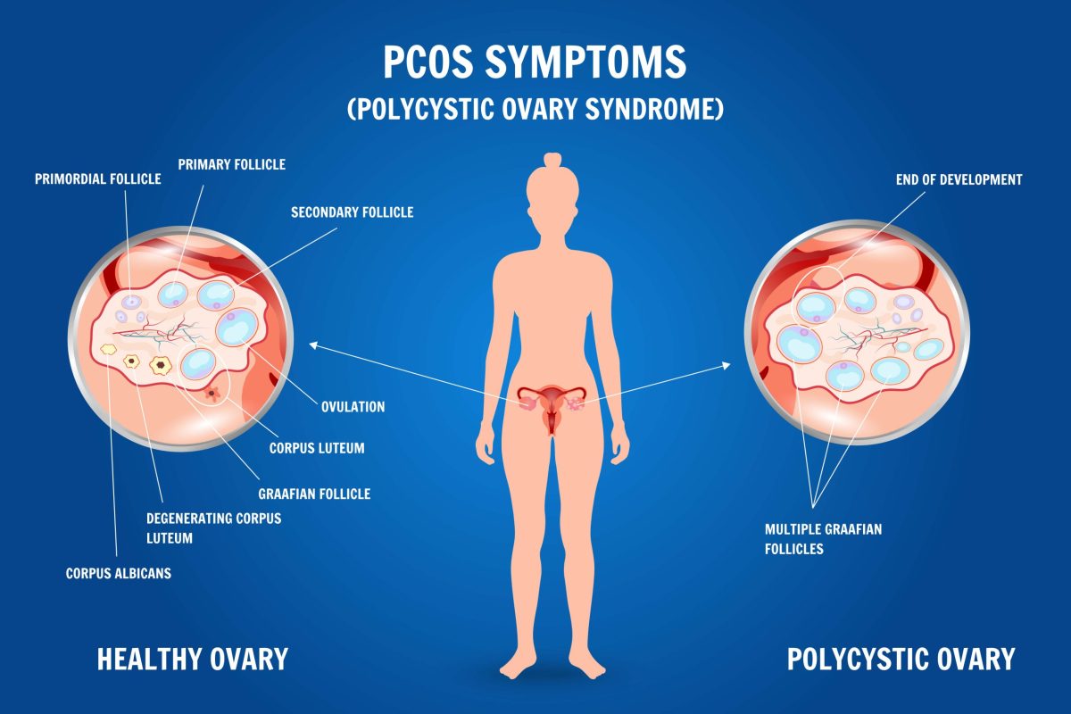 PCOS symptoms illustration showing hormonal imbalance and ovarian changes